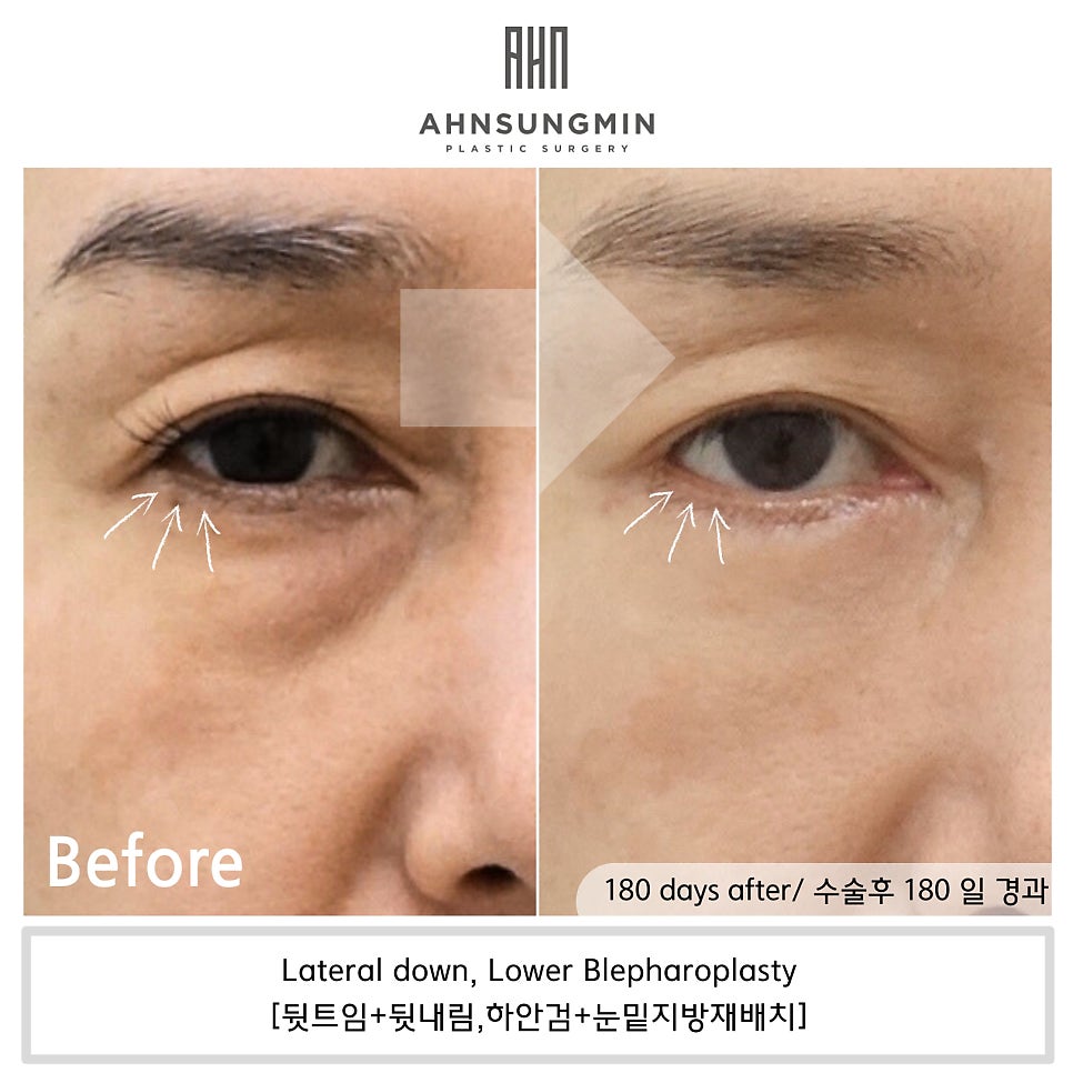 뒷트임과 하안검 수술의 공통 수술 범위. 성형외과 전문의 안성민 관련 이미지 3