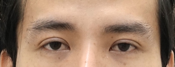 쌍꺼풀이 너무 높은데 재수술이 필요할까요? 관련 이미지 1