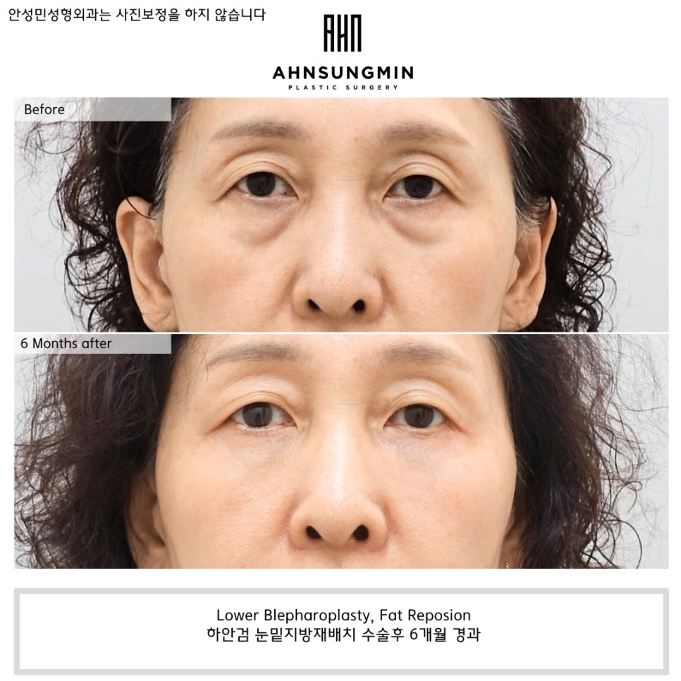 나이대별 눈밑지방재배치 수술 전후 사진 비교 관련 이미지 6
