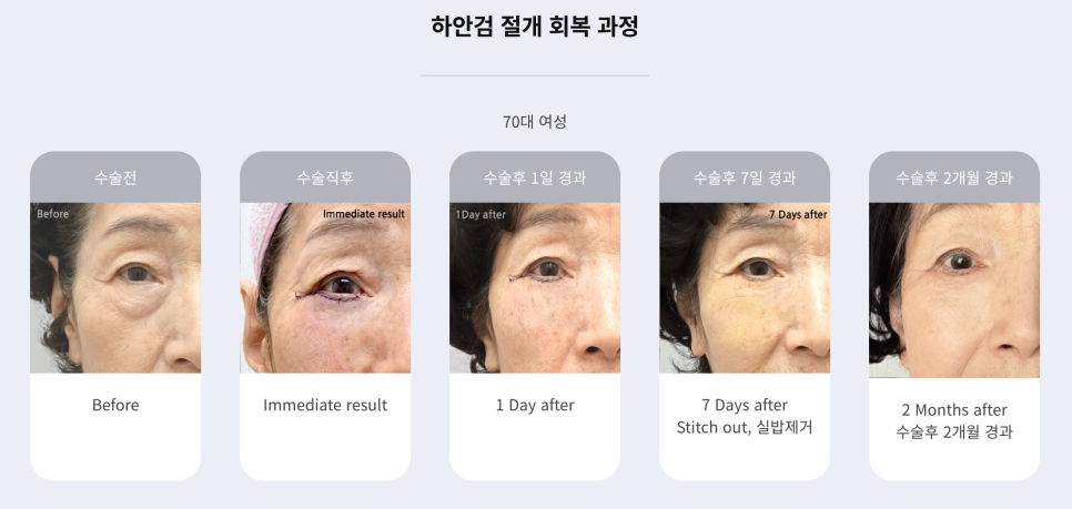 70대 여성 눈 밑 하안검 수술 회복 리얼 후기 관련 이미지 1