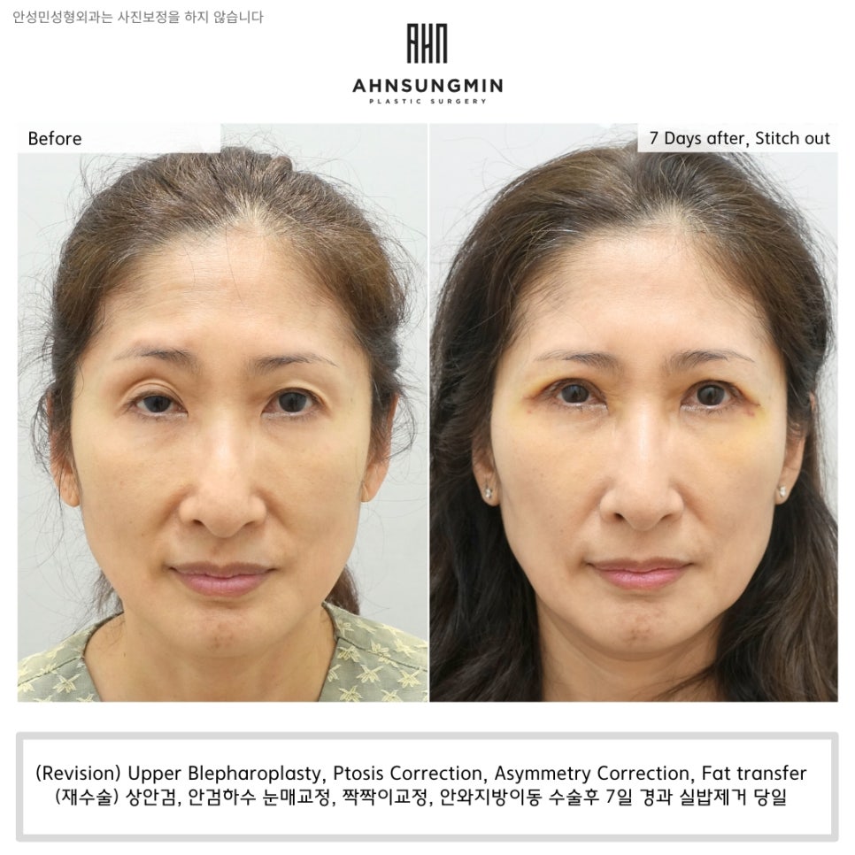 [재수술] 안검하수 짝짝이 교정을 한쪽 눈만 할 수 없는 이유 관련 이미지 3