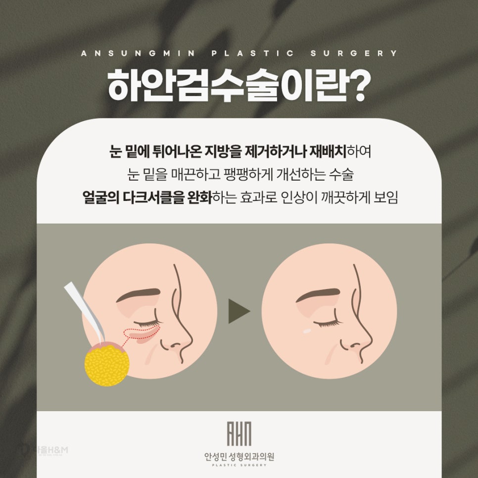 송파구 성형외과 하안검 수술 원한다면, 안성민성형외과 관련 이미지 3