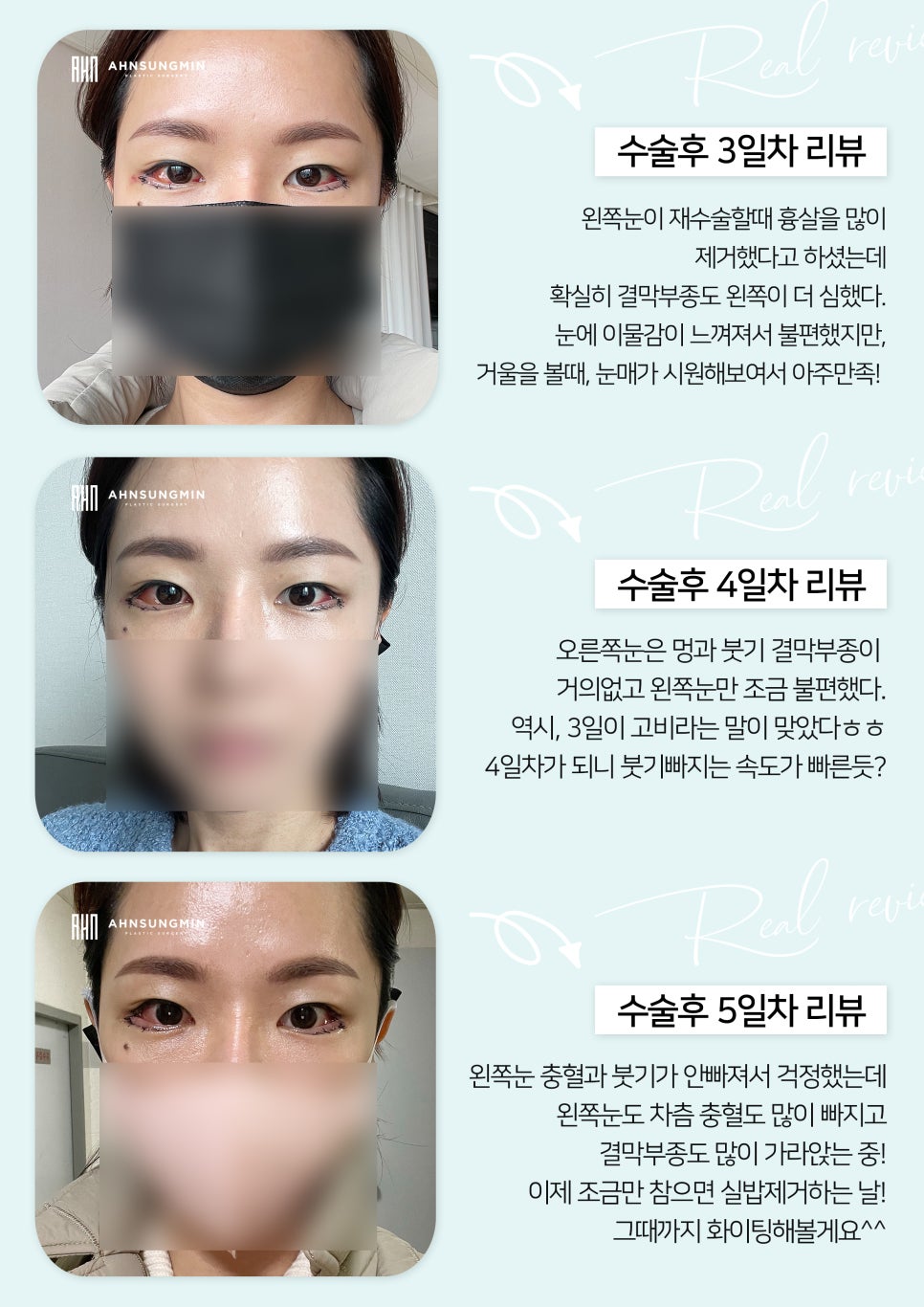 [잠실동성형외과] 듀얼트임 7일차 리얼후기 관련 이미지 3