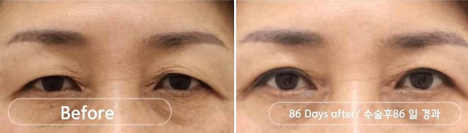 나이대별 상안검 수술, 처진 눈꺼풀을 개선하다 관련 이미지 5