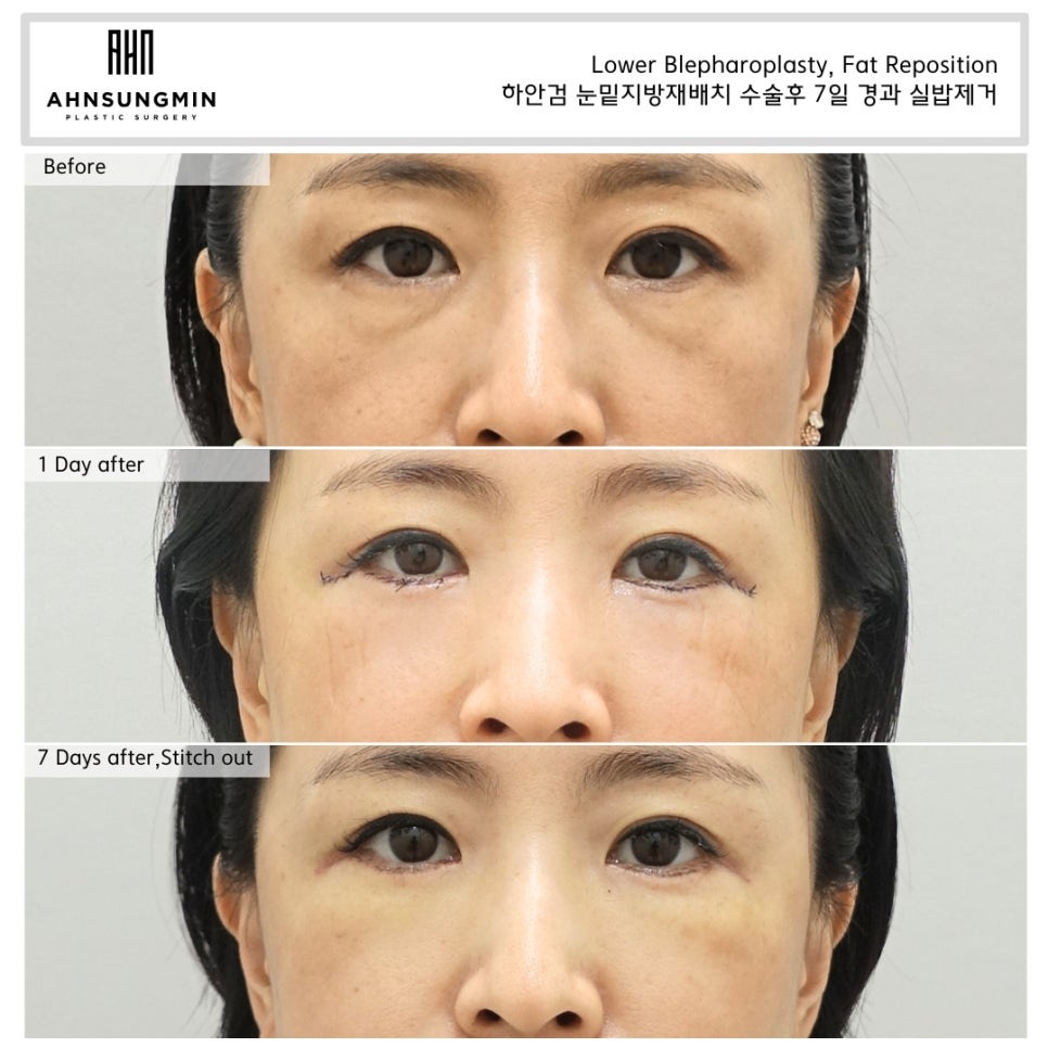 눈밑지방재배치 재수술이 가능할까요? 수술 후 7일 경과 관련 이미지 4