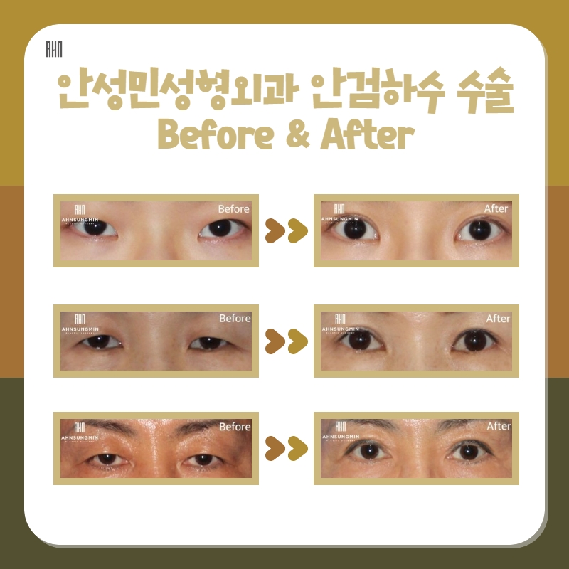 쌍꺼풀수술 나에게 맞는 눈모양으로 관련 이미지 8