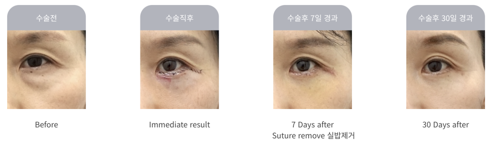 하안검 수술과 중안면 거상의 모든 것 관련 이미지 3