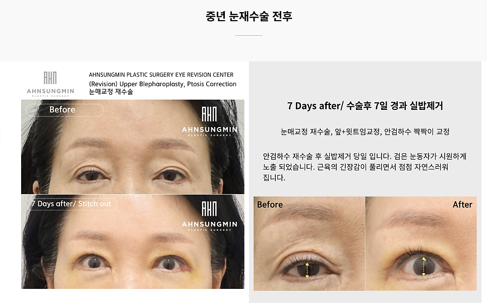 중년 눈 재수술 근본적인 문제 해결 맞춤 재수술 관련 이미지 3