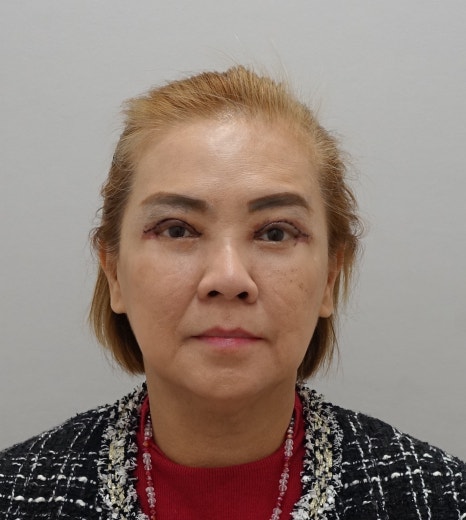 겹주름의 근본적인 원인, 눈 재수술 [성형외과 전문의 안성민] 관련 이미지 4