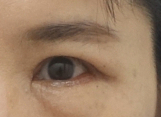 상안검 수술과 뒷트임 수술을 함께 진행하는 이유, 뒷트임의 중요성 관련 이미지 5