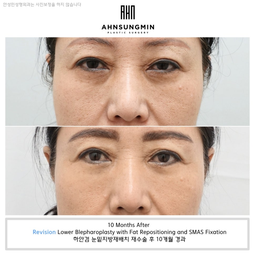 하안검 눈밑지방재배치 재수술, 수술 전후로 살펴봅니다 관련 이미지 2