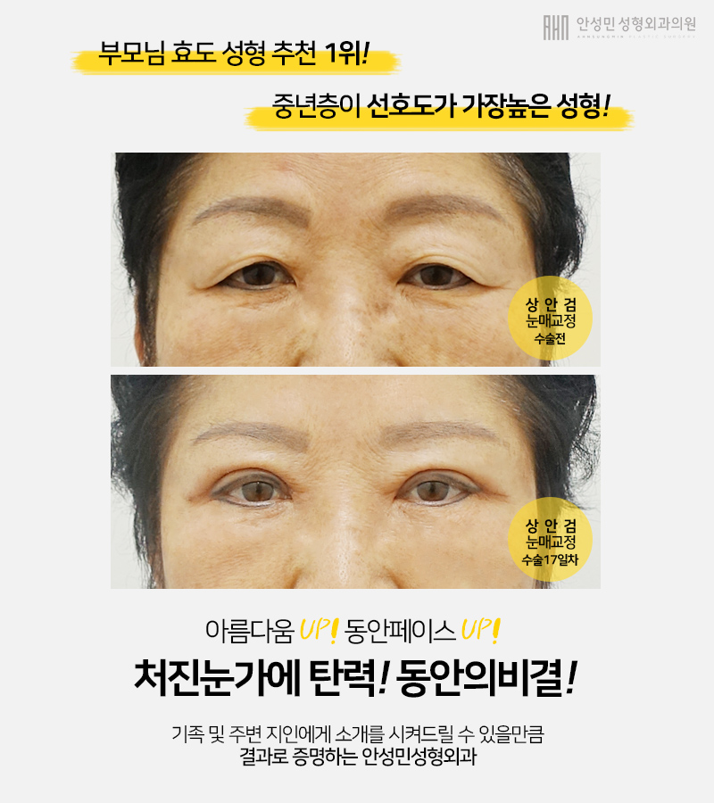 [잠실동성형외과] 젊음의비결! 중년층고객님들도 상안검눈매교정으로 눈가 주름 및  처짐개선 동안페이스 완성!! 관련 이미지 2