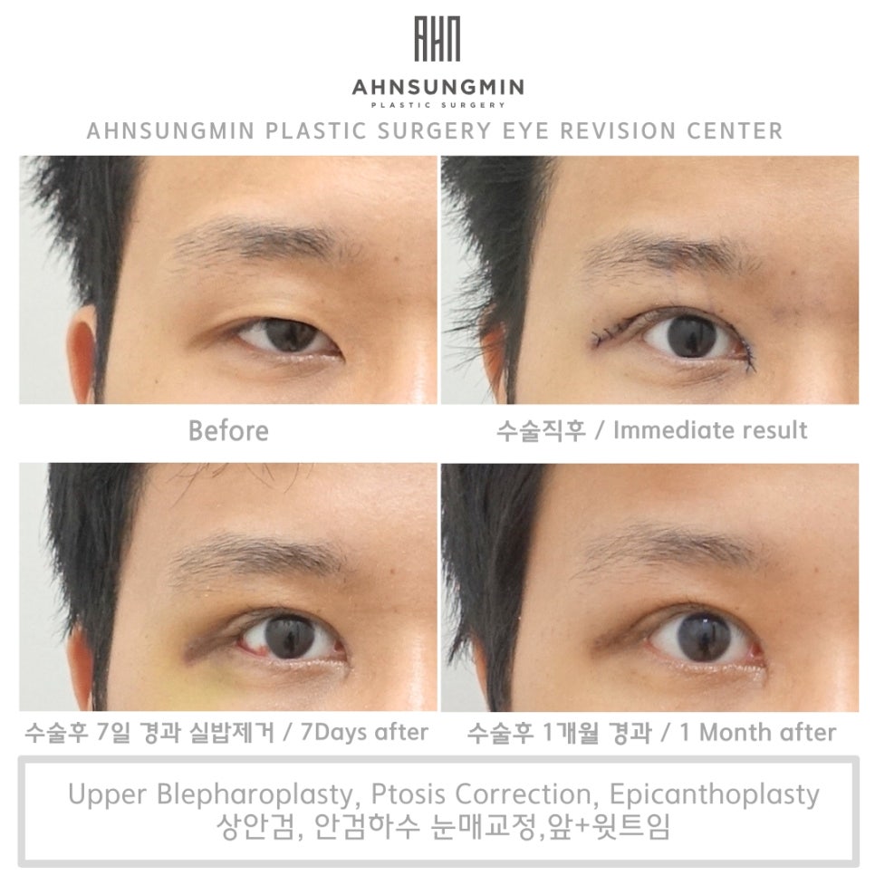 20대 남자 안검하수 수술 전후, 성형외과 전문의 관련 이미지 5
