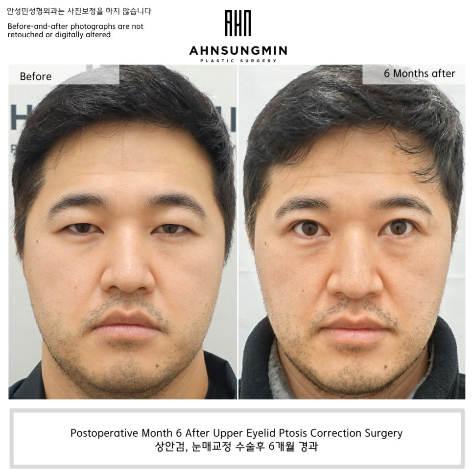 상안검, 눈매교정 수술 후 6개월 경과 &ndash; 눈뜨는 힘이 달라지면 인상이 달라집니다 관련 이미지 1