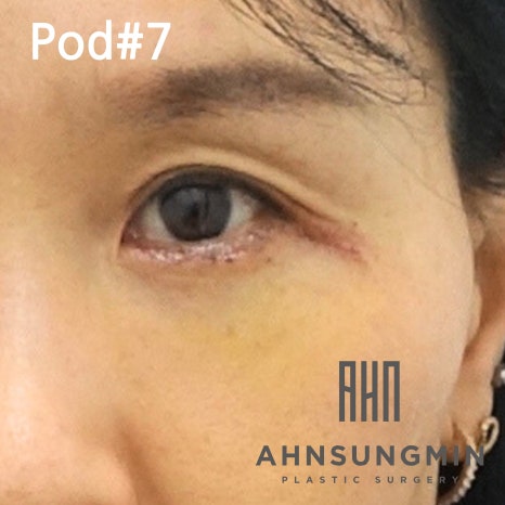 중년의 눈밑지방재배치 수술과 회복 과정 알아보기 관련 이미지 5