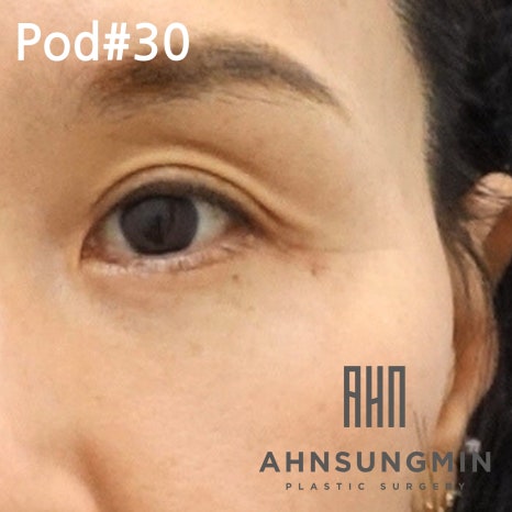 중년의 눈밑지방재배치 수술과 회복 과정 알아보기 관련 이미지 6