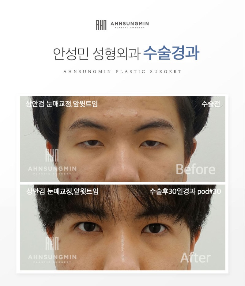 하안검수술비용 부작용이 고민이라면 관련 이미지 5