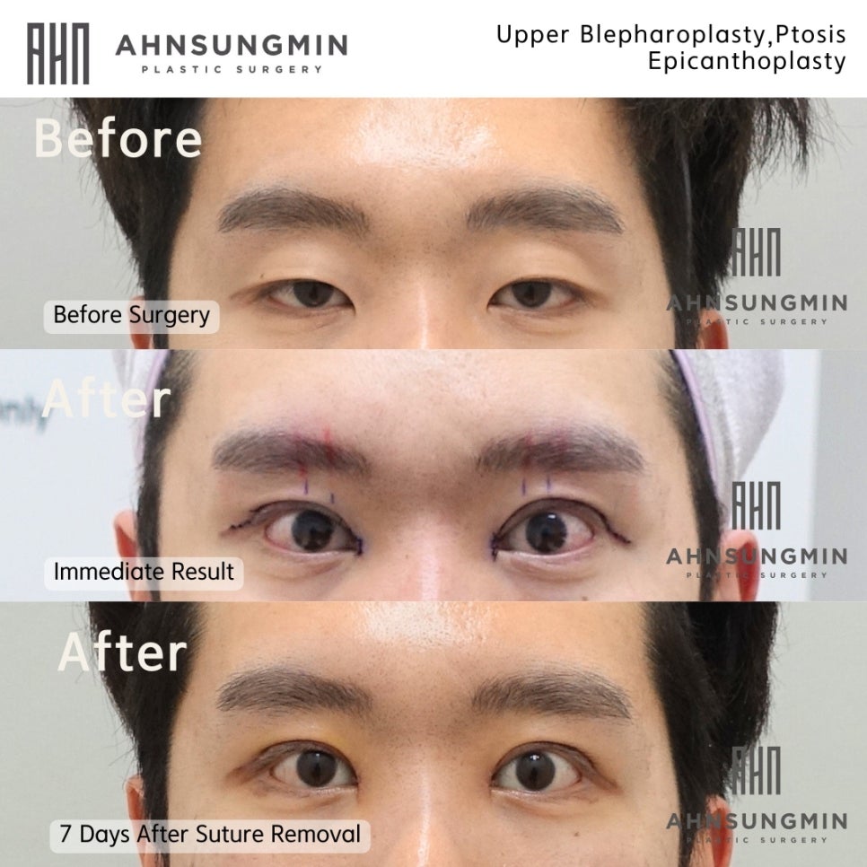 20대 남성 자연스러운 쌍꺼풀 실밥제거 당일 관련 이미지 1