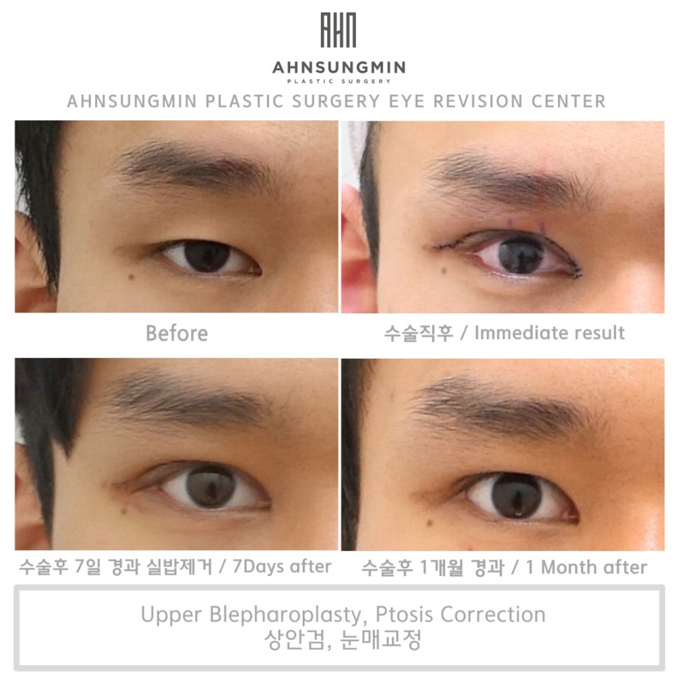 미세한 차이가 주는 매력적인 눈 남자 눈매교정 잘하는 병원 관련 이미지 2