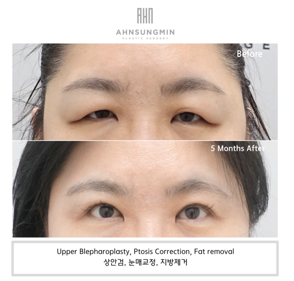 눈꺼풀이 무거울 때, 눈두덩이 지방제거 관련 이미지 2