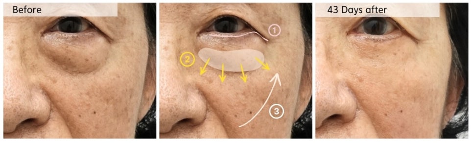 하안검 수술 시 중안면 근육 거상의 중요성 [성형외과 전문의 안성민] 관련 이미지 5