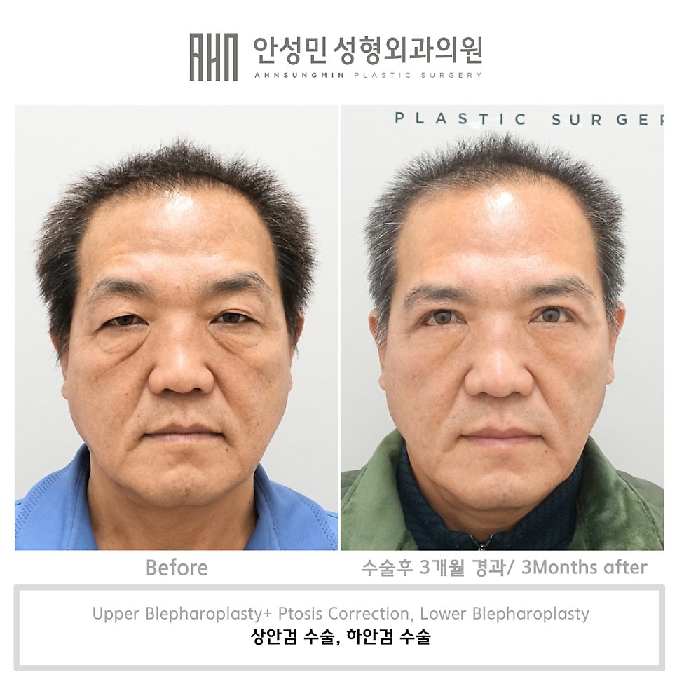 하안검 교정술과 중안면 거상의 중요성 관련 이미지 4