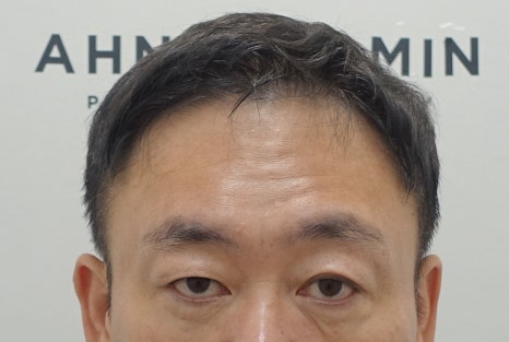 남자 짝짝이 쌍꺼풀 교정 후 32일 경과 [성형외과 전문의 안성민] 관련 이미지 3