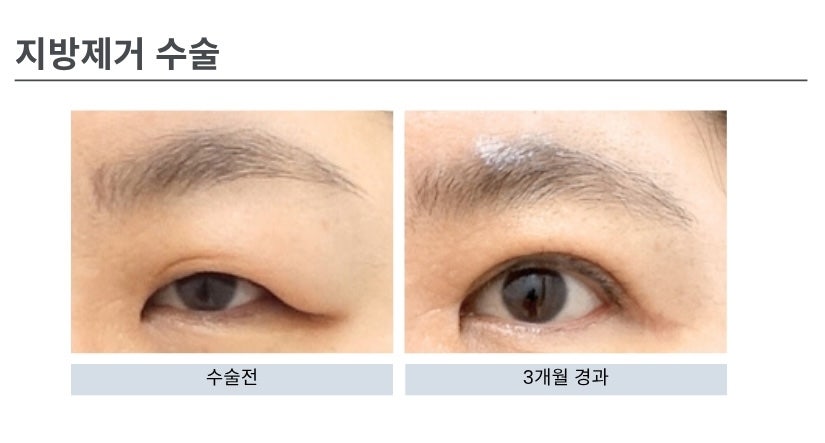 상안검 수술의 모든 것 관련 이미지 2