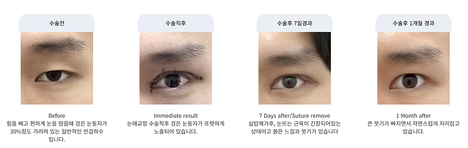 남자 눈성형 두꺼운 쌍꺼풀 풀기 관련 이미지 1