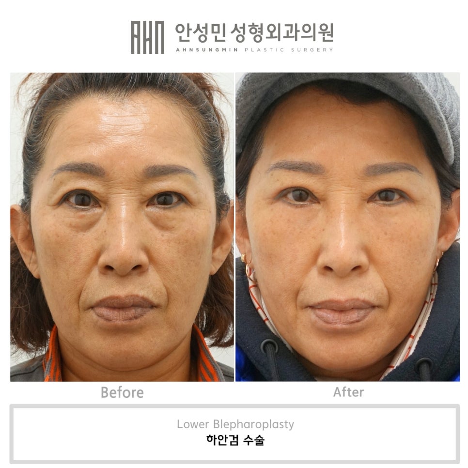 하안검 교정술과 중안면 거상의 중요성 관련 이미지 3