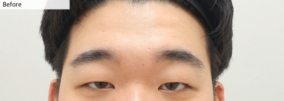 [4개월 경과] 남자 안검하수 수술의 핵심 포인트!! 관련 이미지 1