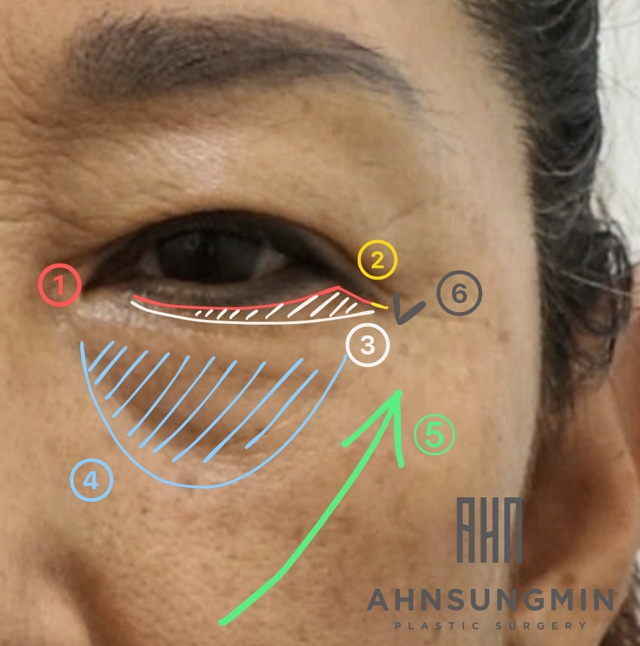 하안검 교정술과 중안면 거상의 중요성 관련 이미지 2