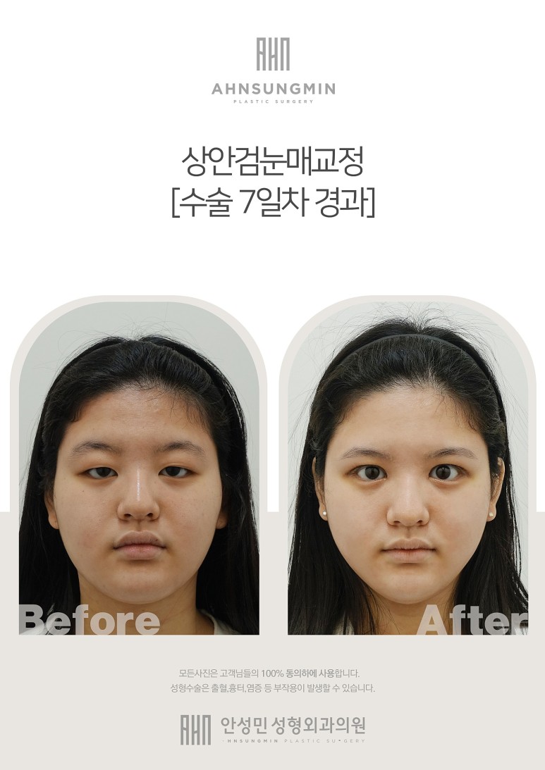 "눈매교정" 무엇일까? 관련 이미지 2