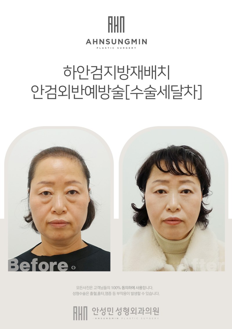 하안검 지방재배치 관련 이미지 1