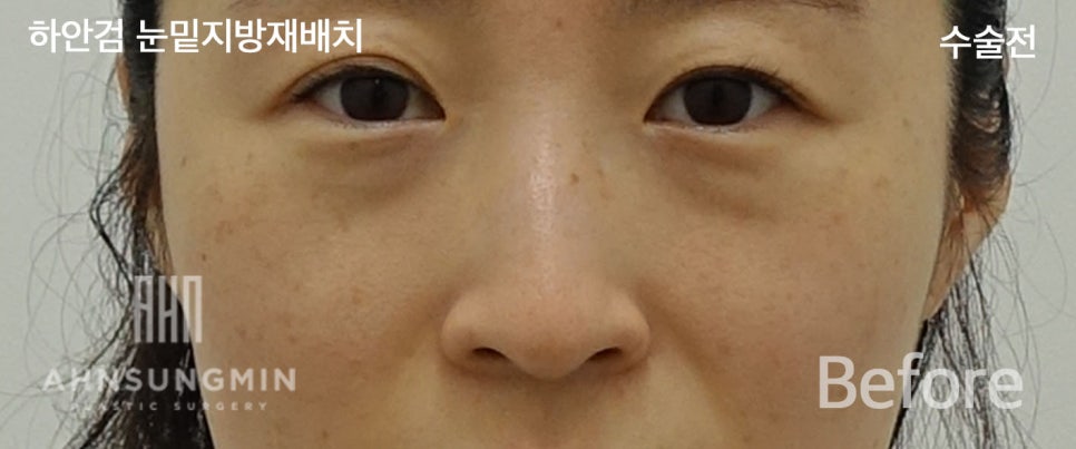 [안성민 성형외과]하안검지방재배치 고객님입니다^^ 관련 이미지 2