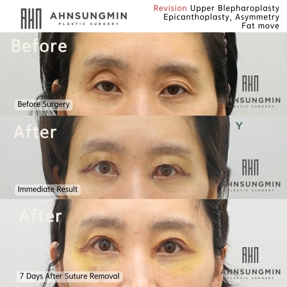 중년 눈재수술 눈꺼짐과 지방이동 관련 이미지 1