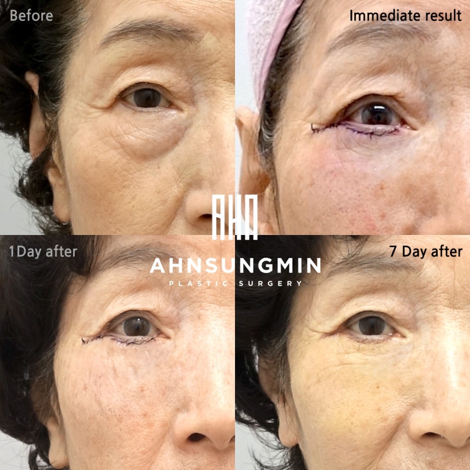 노년의 하안검 수술 주의점, 70대 여성 하안검 눈밑지방재배치 첫수술 관련 이미지 4