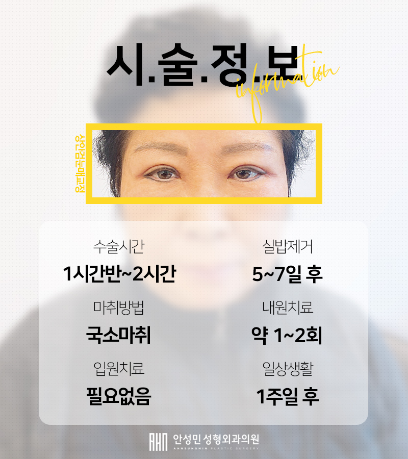 [잠실동성형외과] 젊음의비결! 중년층고객님들도 상안검눈매교정으로 눈가 주름 및  처짐개선 동안페이스 완성!! 관련 이미지 3