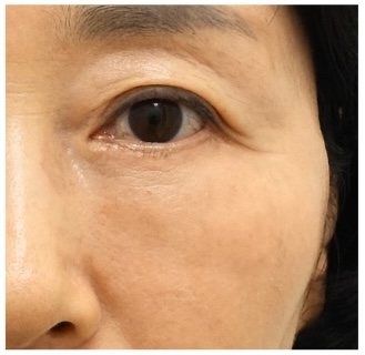 하안검 지방재배치 재수술, 정말 가능한가요? 관련 이미지 5