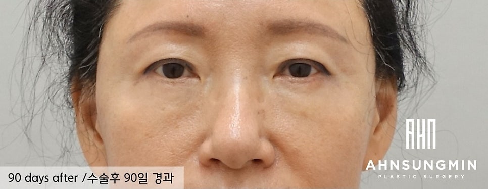 불룩한 눈 밑 지방, 해결할 수 있을까? 관련 이미지 4