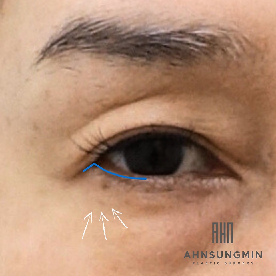 뒷트임과 하안검 수술의 공통 수술 범위. 성형외과 전문의 안성민 관련 이미지 2