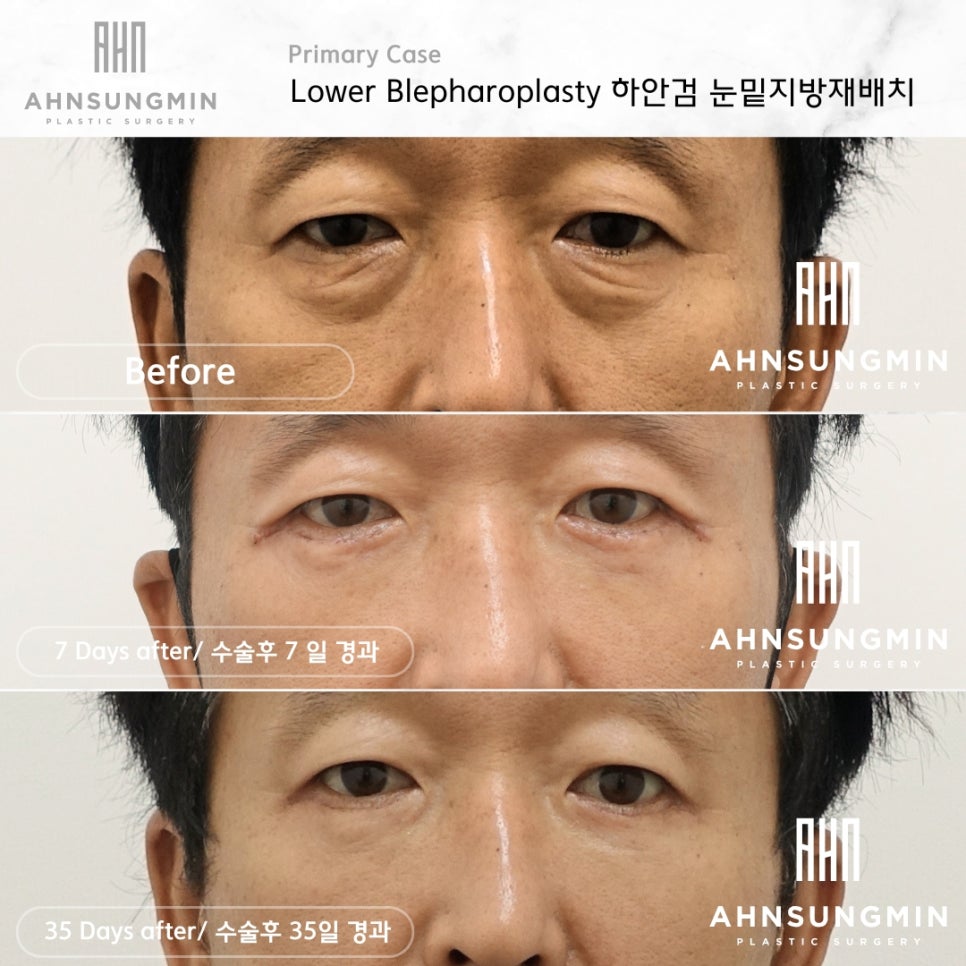 중년 남자 눈 밑 수술 후회 없이 안전하게 잘하려면 [성형외과 전문의 안성민] 관련 이미지 1