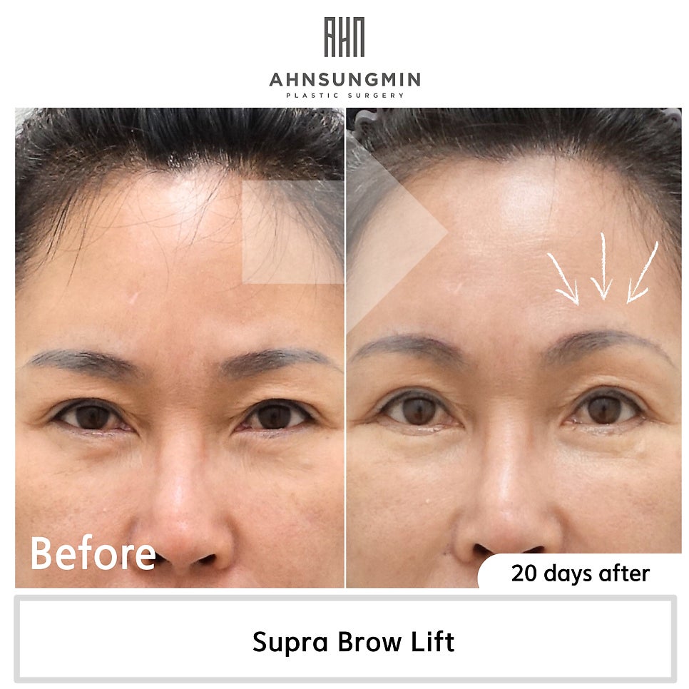 왜 쌍꺼풀이 눌려 보일까? 관련 이미지 3