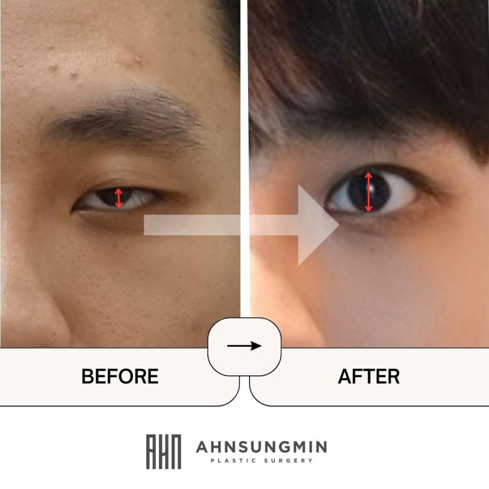 안검하수로 생기는 증상과 안검하수 자가진단 관련 이미지 3