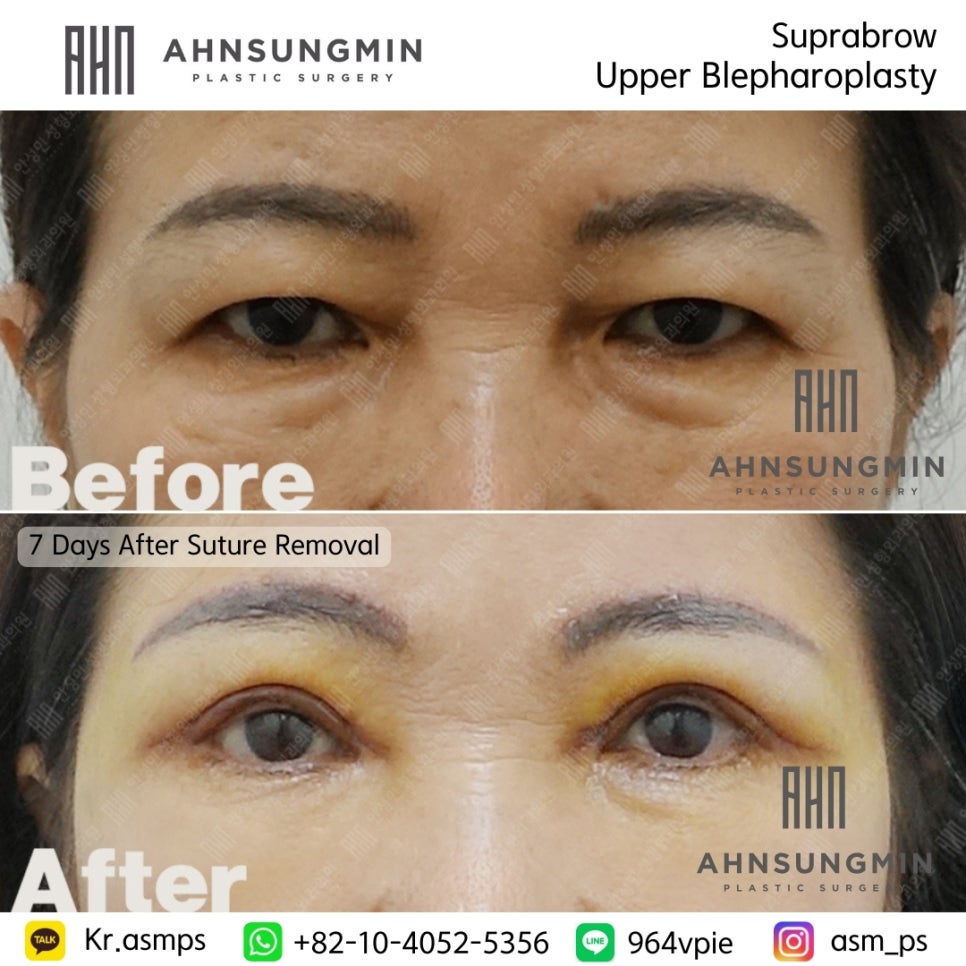 눈썹상거상과 상안검 성형외과 전문의 관련 이미지 5