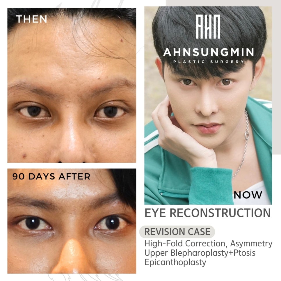 남자 눈성형 하이폴드 교정(High-fold correction) 관련 이미지 3