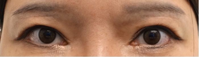 눈썹하거상 후 눈썹 모양, 눈썹하거상 부작용을 겪지 않으려면?잠실성형외과 관련 이미지 5