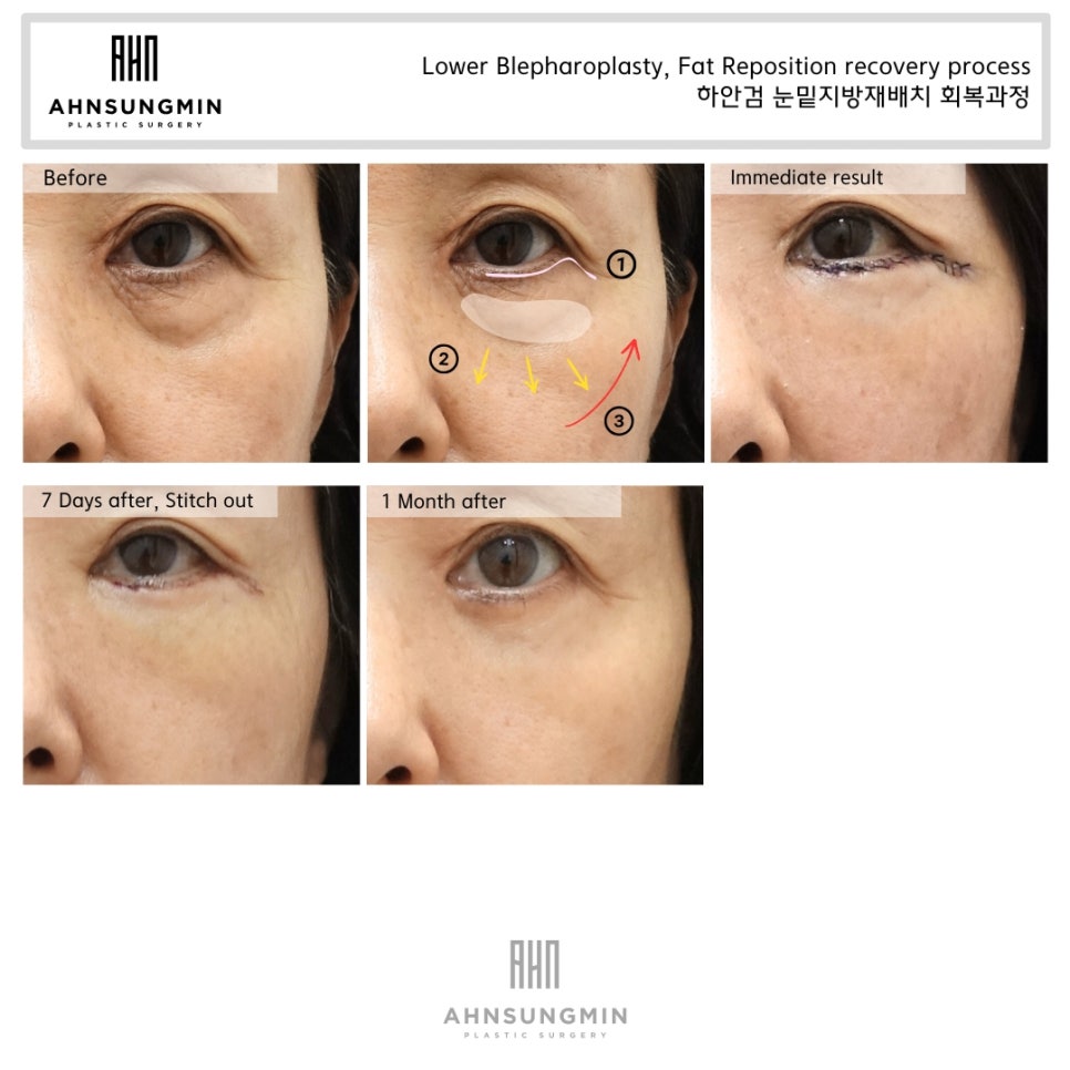 하안검 수술 시 중안면 근육을 당기는 이유 관련 이미지 3