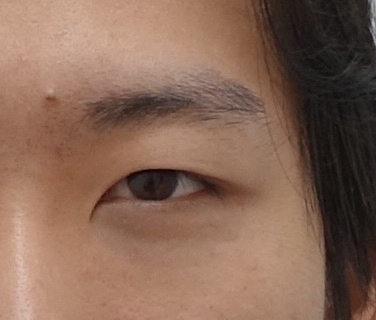 생기있는 남자 눈매완성, 안검하수 눈매교정 관련 이미지 3