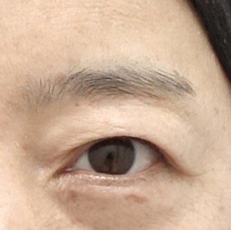 눈썹 상거상 수술이 필요한 이유와 눈썹 하거상 수술의 부작용 관련 이미지 3